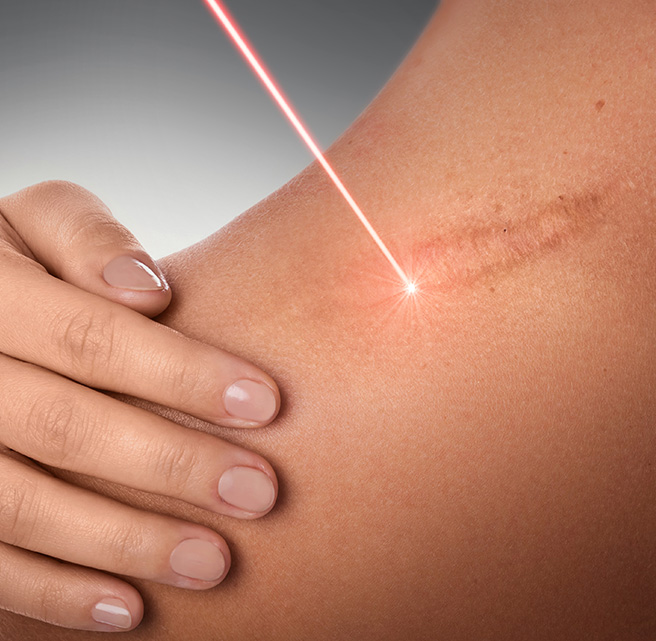 Laser Treatment for Keloid Scars