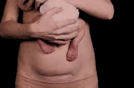 C section: "keloid scars" picture