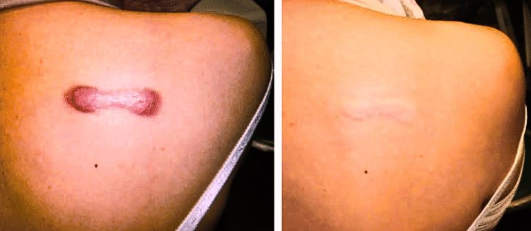 Laser Treatment for Keloid Scars