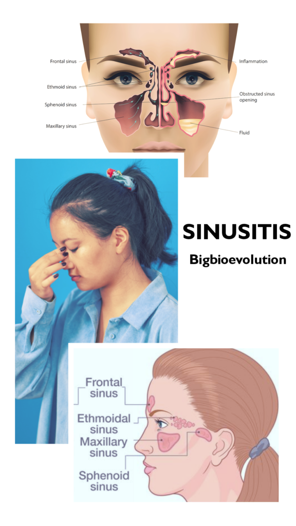 Sinusitis-top-10-ayurvedic-medicines